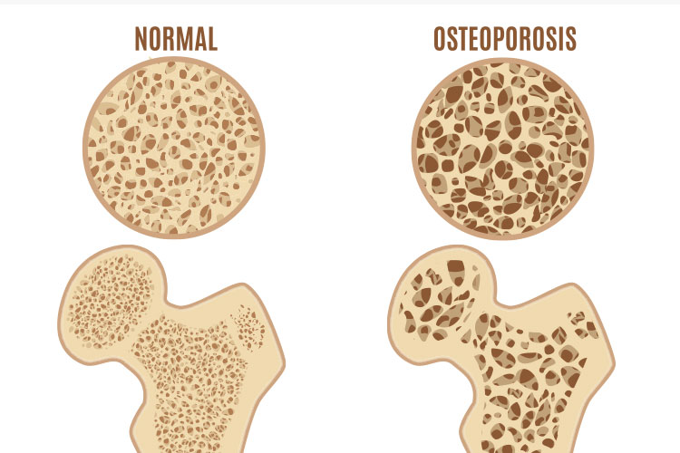 骨粗しょう症のイメージ写真