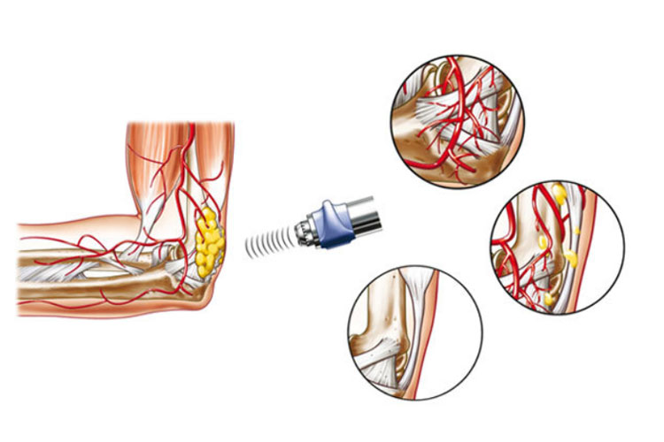 慢性炎症の治療
